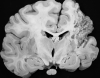 Cavitating middle cerebral artery infarct with secondary corticospinal tract degeneration